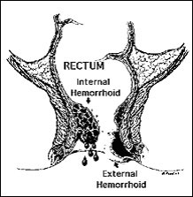 internal-hemorrhoids-symptoms-external-hemorrhoids